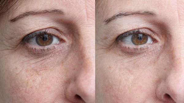 Closeup of eye area before and after facial treatment